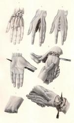 Operative Tafel LVIII. Exarticulation der Mittelhandknochen und der Hand