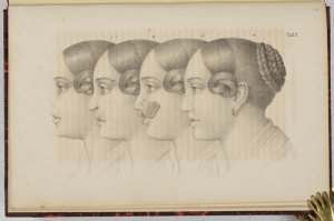 Beiträge zur praktischen Chirurgie. Nebst Bericht über die chirurgisch-augenärztliche Klinik der Königlichen Universität zu Halle für die Zeit von 1831 […]