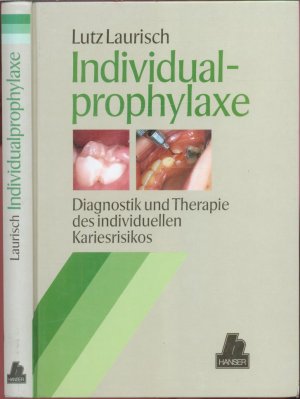 Individualprophylaxe. Diagnostik und Therapie des individuellen Kariesrisikos