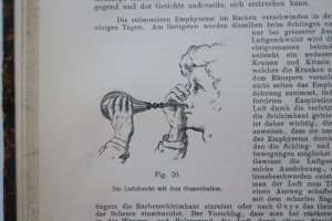 Politzer, Adam. Lehrbuch der Ohrenheilkunde für practische Ärzte und Studirende. Zweite (2.), gänzlich umgearbeitete Auflage. Stuttgart, Verlag von Ferdinand […]