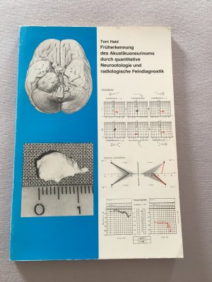 Früherkennung des Akustikusneurinoms durch quantitative Neurootologie und radiologische Feindiagnostik