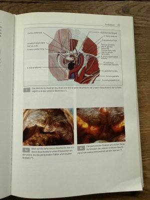 gebrauchtes Buch – Reinhard Bittner – Laparoskopische Hernioplastik