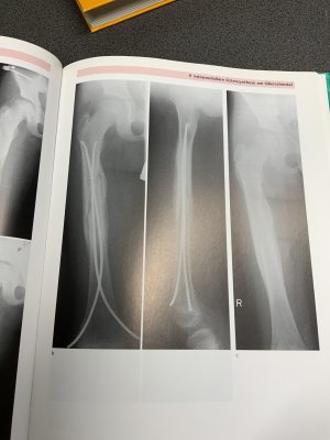 gebrauchtes Buch – Dietz, H G; Schmittenbecher, P P; Illing, P – Intramedulläre Osteosynthese im Wachstumsalter