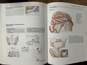 gebrauchtes Buch – W.Lierse, H.W – Peritoneum, Staging-Laparotomies, Leber, Pfortader, Milz