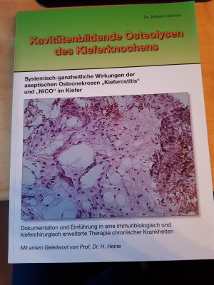 Kavitätenbildende Osteolysen des Kiefernknochens - Systemisch-ganzheitliche Wirkungen der aseptischen Osteonekrosen "Kieferostitis"