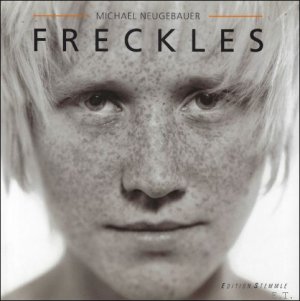 Freckles