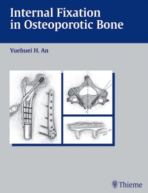 Yuehuei H. An (Autor) - Internal Fixation in Osteoporatic Bone