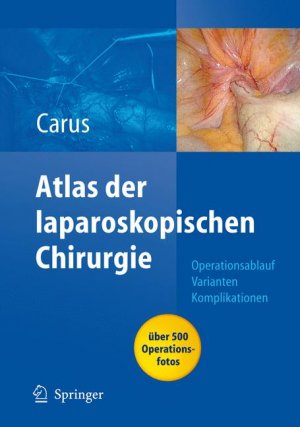 gebrauchtes Buch – Thomas Carus – Atlas der laparoskopischen Chirurgie: Operationsablauf - Varianten - Komplikationen (Gebundene Ausgabe) von Thomas Carus