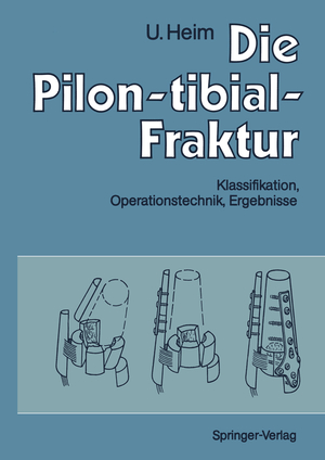 ISBN 9783642759604: Die Pilon-tibial-Fraktur - Klassifikation, Operationstechnik, Ergebnisse